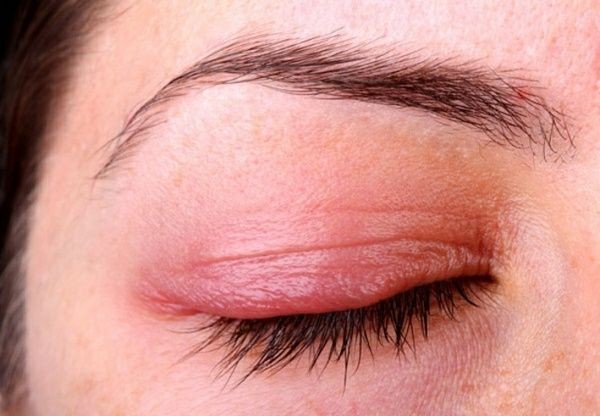 6.   Menghilangkan Mata Bengkak yang Mengganggu Penampilan Wajah