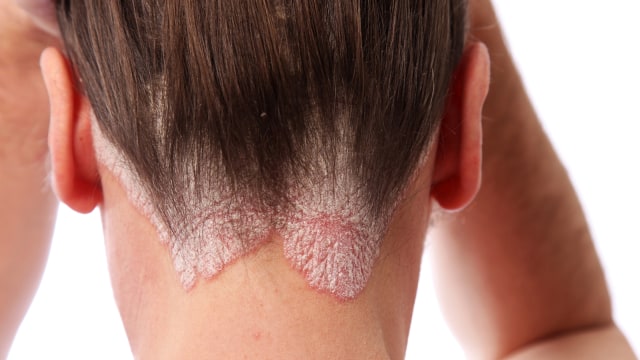 7. Atasi Gejala Psoriasis