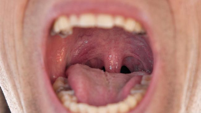 4. Meredakan Gatal dan Ruam Pada Mulut